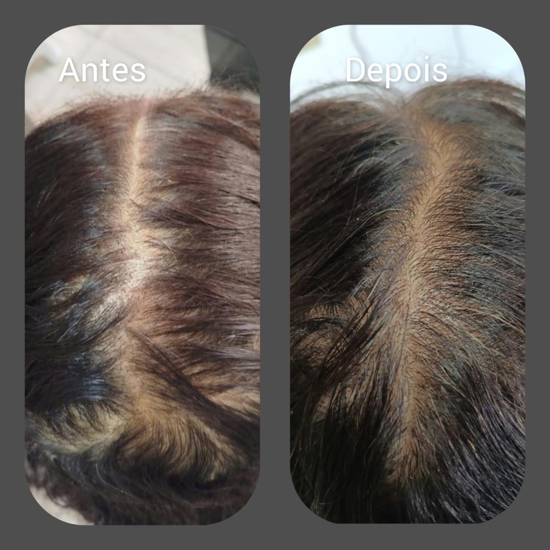 Comparação de antes e depois do couro cabeludo de paciente acompanhada
