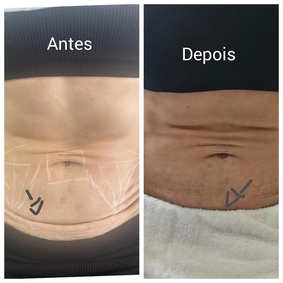 Antes e depois de procedimento de estética corporal